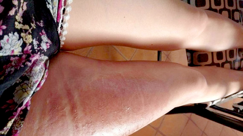 Se quemó casi medio cuerpo con el líquido de la funda de su smartphone