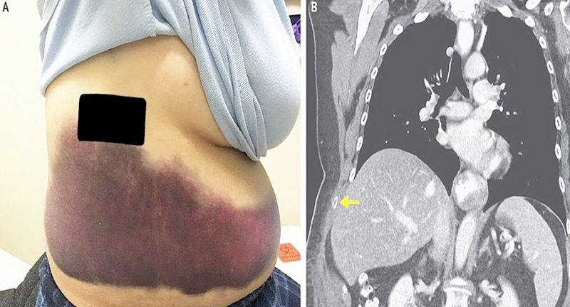 Una mujer se quebró una costilla al sufrir un ataque de tos