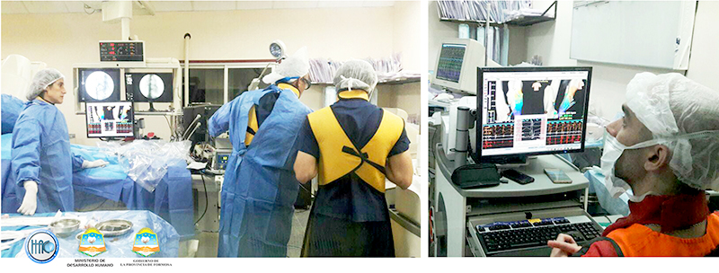 HAC: Ablación por Radiofrecuencia 3D