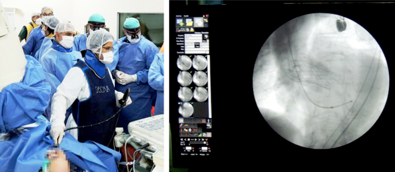 El HAC y un novedoso sistema para reemplazar una válvula cardíaca