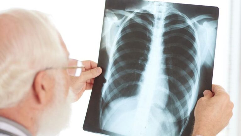 Día Mundial de la Tuberculosis: La importancia del diagnóstico y completar el tratamiento