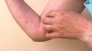 Viruela del mono: Hasta el momento, los contactos del caso positivo no presentan síntomas