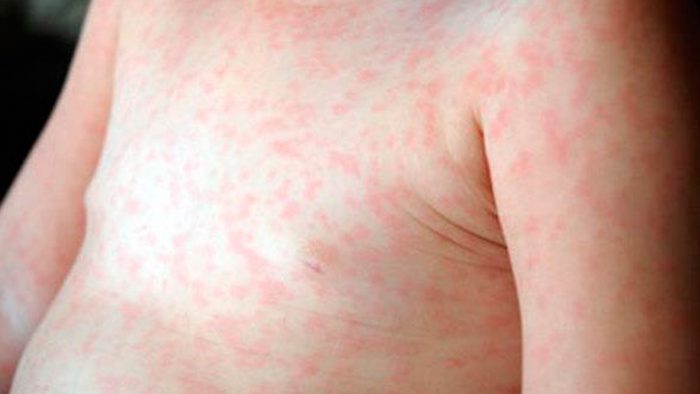 Fueron notificados cuatro nuevos casos de sarampión en la Argentina