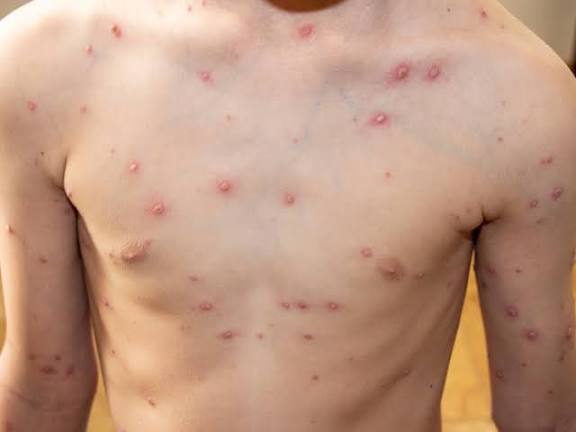 El Ministerio de Desarrollo Humano lleva adelante acciones ante la aparición de casos compatibles con varicela